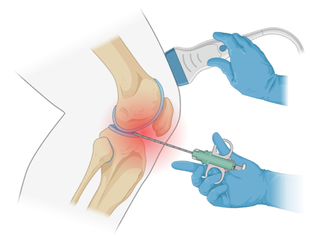 Synovial A graphic of a synovial biopsy